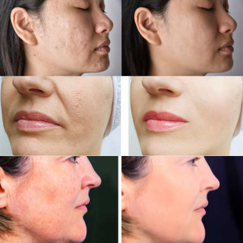 MicroGlow stylo microneedling